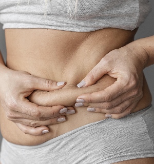 Stretch marks