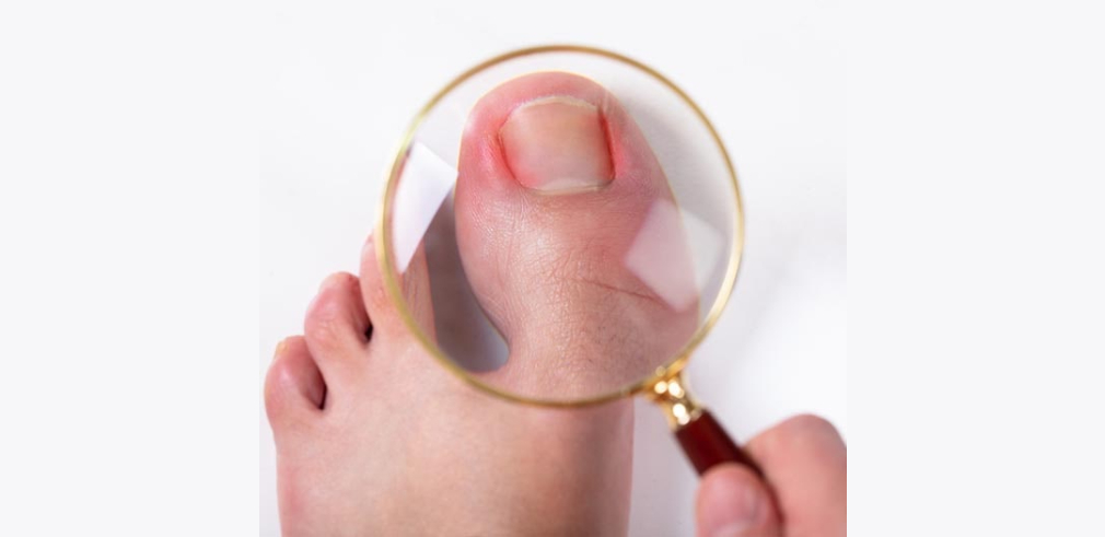 Chronic Paronychia